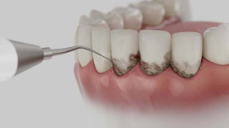 Trusted Dental Implants service in Somerset, MD - Dentist Open Now